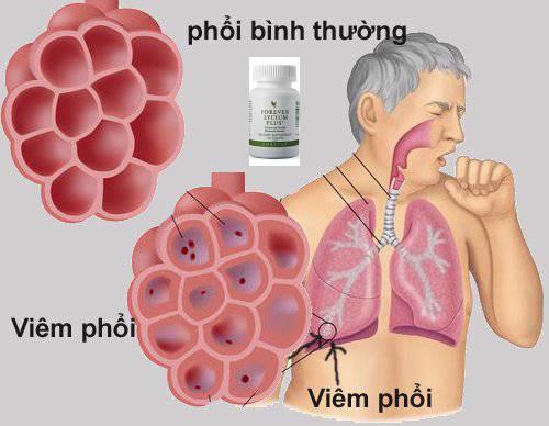 Viên cam thảo FLP dùng cho người bị bệnh lao phổi hoặc ung thư phổi